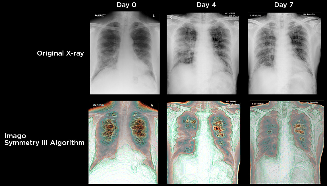 Covid-19 imaging comparison between traditional x-ray and the enhanced Imago Systems VI® Platform images.