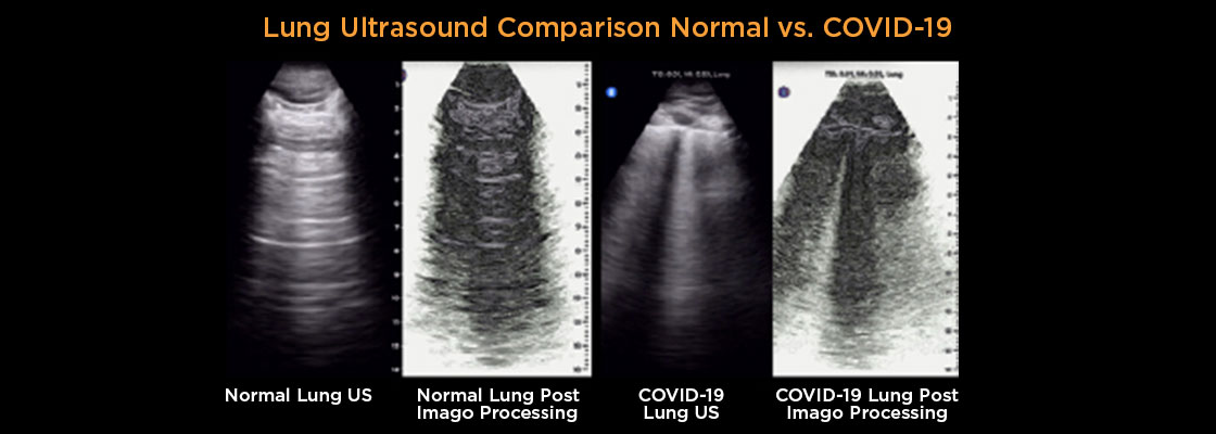 Covid-19 imaging of a normal lung vs. a covid-19 lung & a traditional ultrasound vs. an Imago enhanced image.