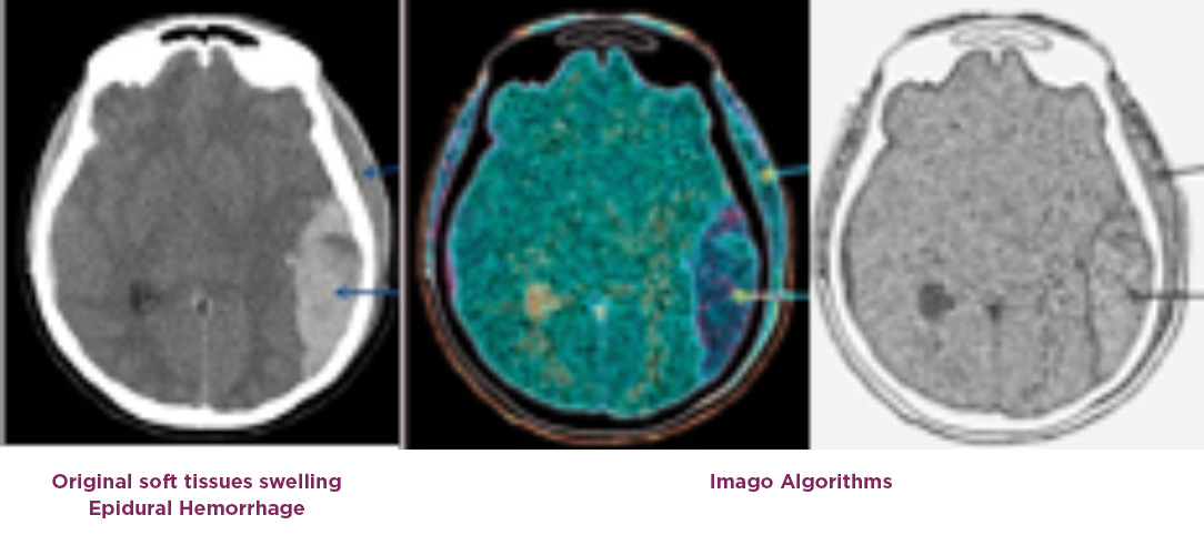 Glioblastoma imaging shows epidural hemorrhage using traditional vs. Imago Systems enhanced VI® Platform