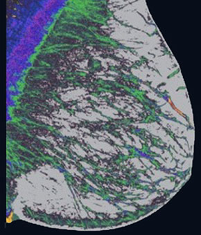 Human imaging of breast tissue enhanced by Imago Systems' Visual Intelligence® cloud-based platform.