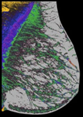 Breast imaging using the Imago Systems, Inc. color island algorithm to identify breast cancer sooner and with more accuracy.