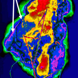 Image #1 with the Imago visual intelligence enhancements is colorful and cancer tissues is easy to spot.