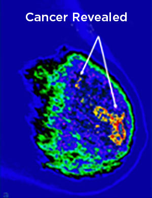 Breast imaging using Imago Systems Visual Intelligence® diagnostic platform where definable cancer is revealed.