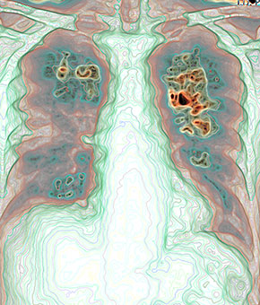 Human imaging of a multicolored chest x-ray enhanced by Imago Systems' Visual Intelligence® cloud-based platform.